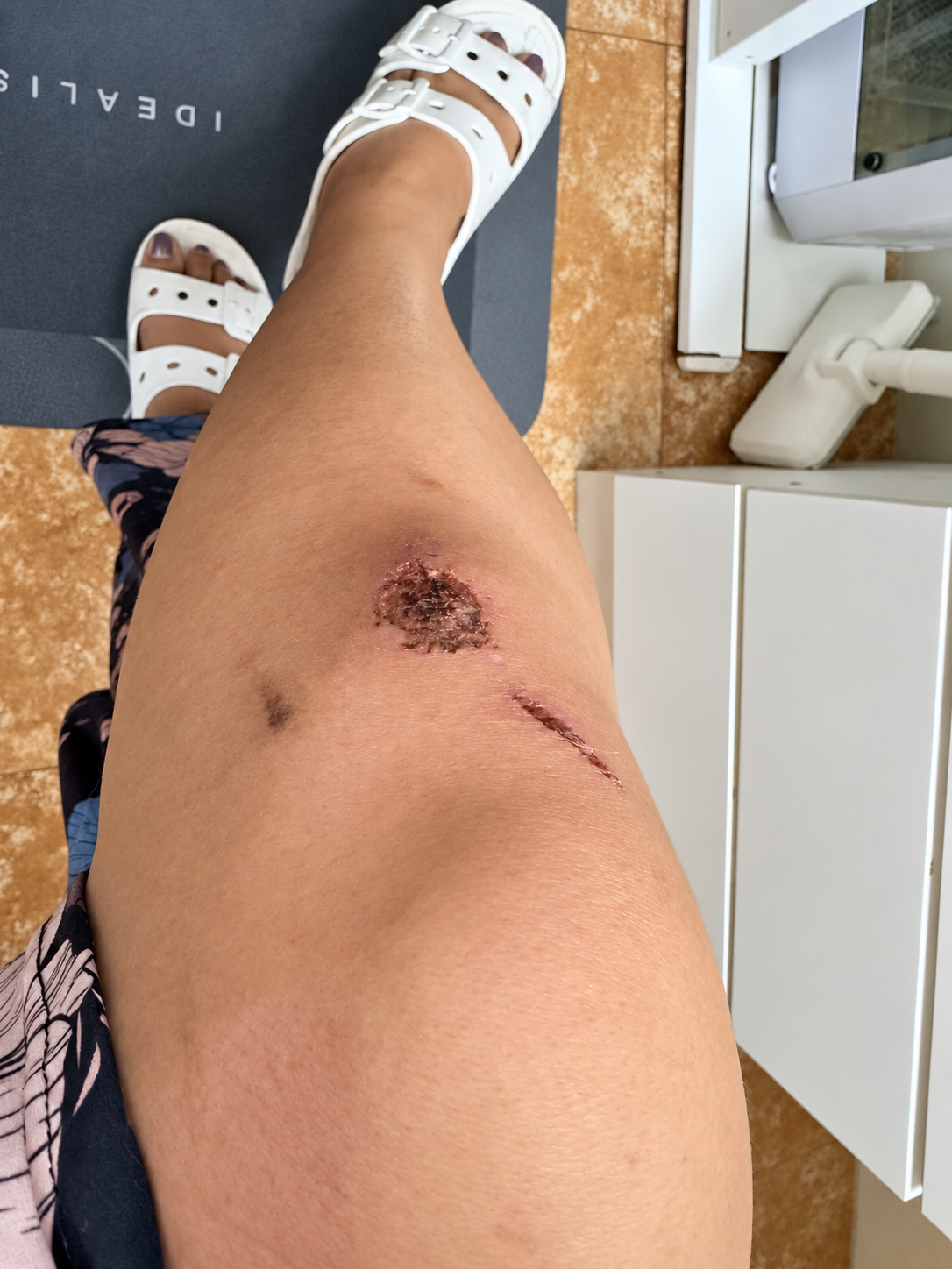 Small scratches from a biking mishap outside the new house